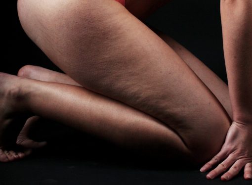 Un nuovo modo per combattere la cellulite